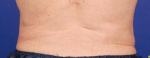 Coolsculpting of the love handles After